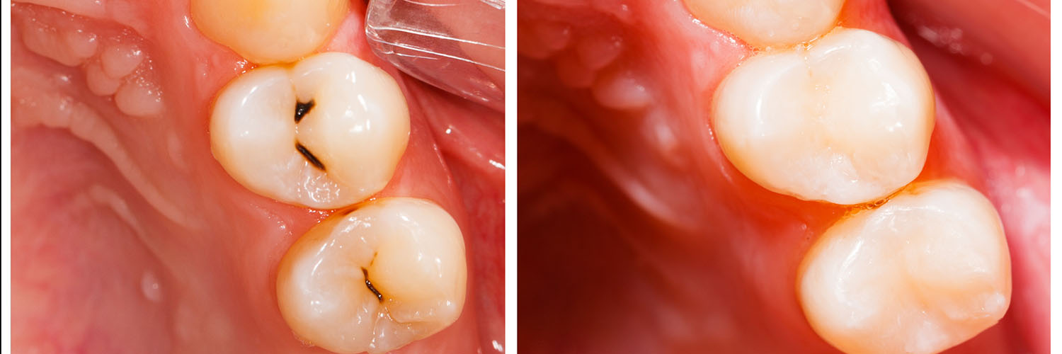 Sunset Dental | Inlays  amp  Onlays, Sedation Dentistry and Full Mouth Reconstruction