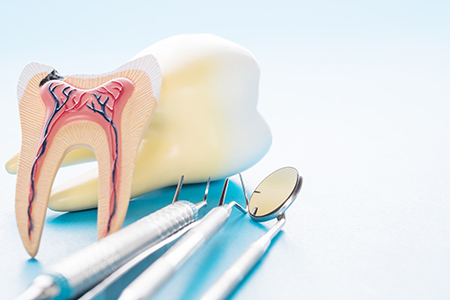 Sunset Dental | Inlays  amp  Onlays, Periodontal Treatment and Root Canals